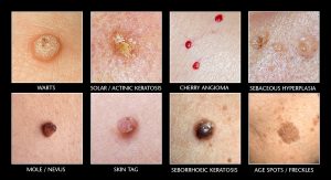 Different types of skin lesion